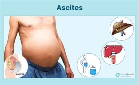 how do you say ascites.